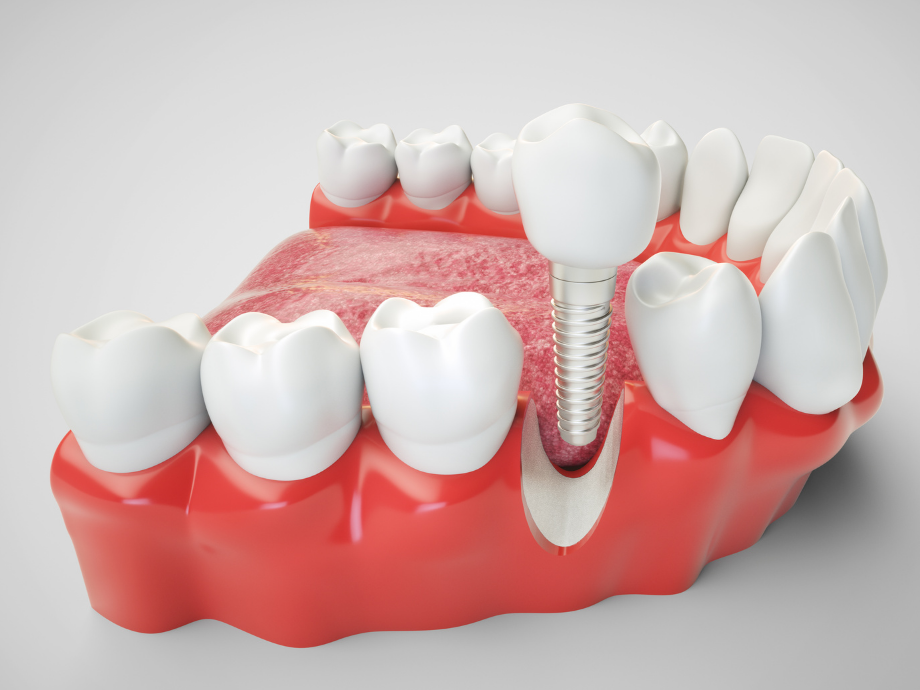 dental_implants_Yorkville_dentist