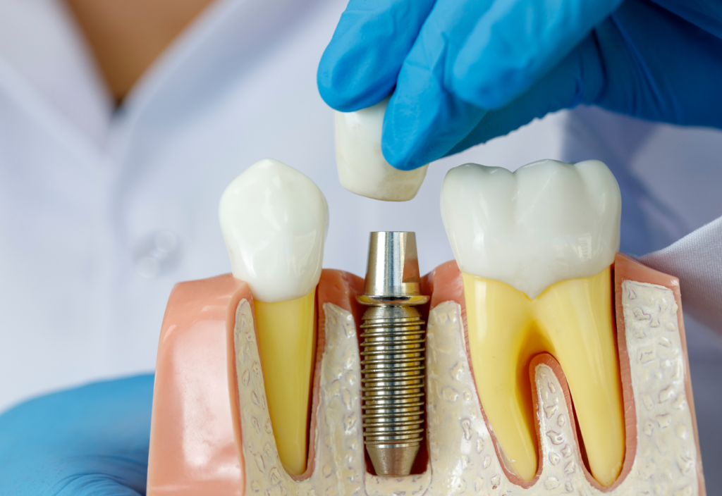 Dental Implants A Forever Solution Dr Judy Sturm And Associates 