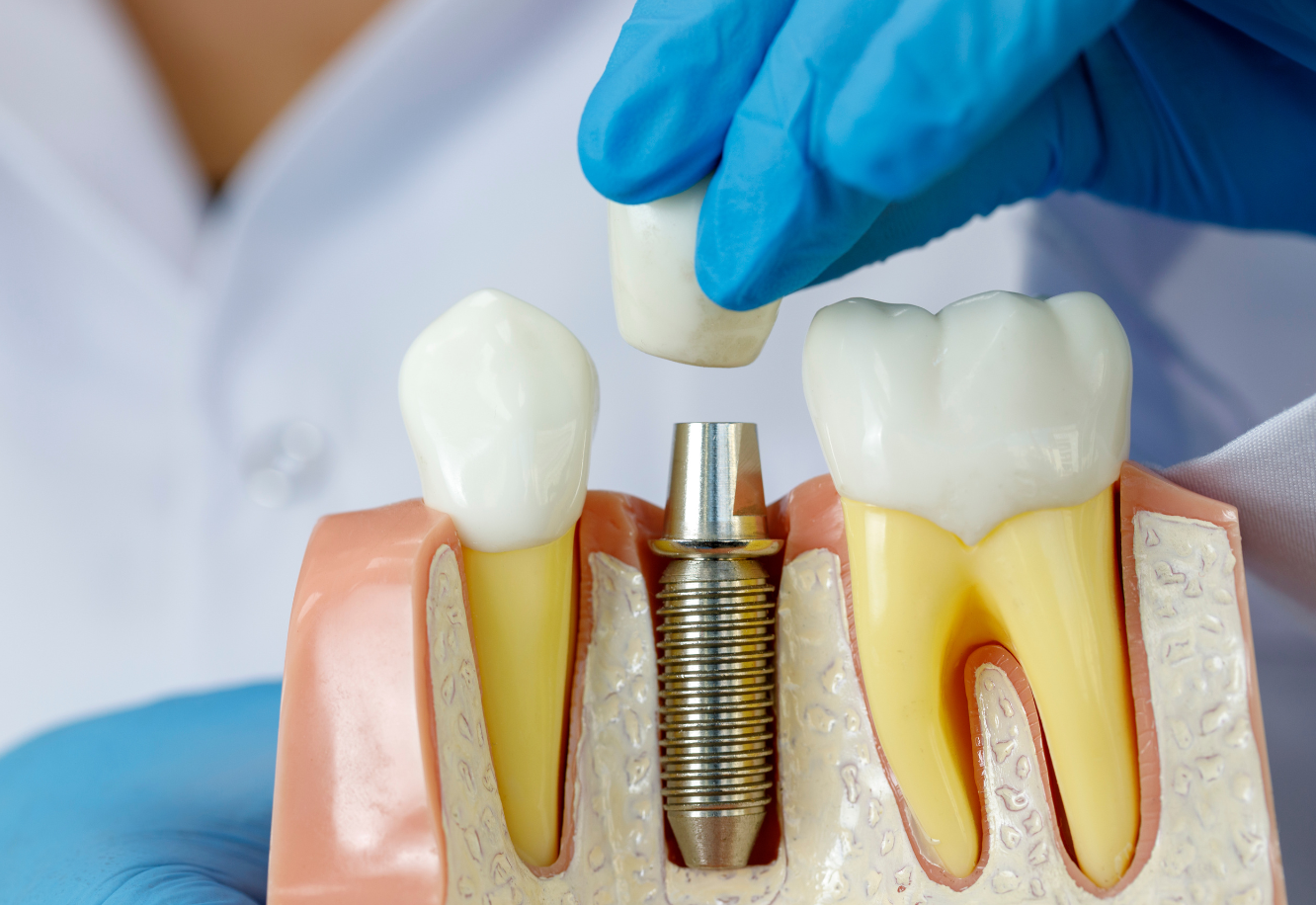 dental_implants_dentist_Toronto